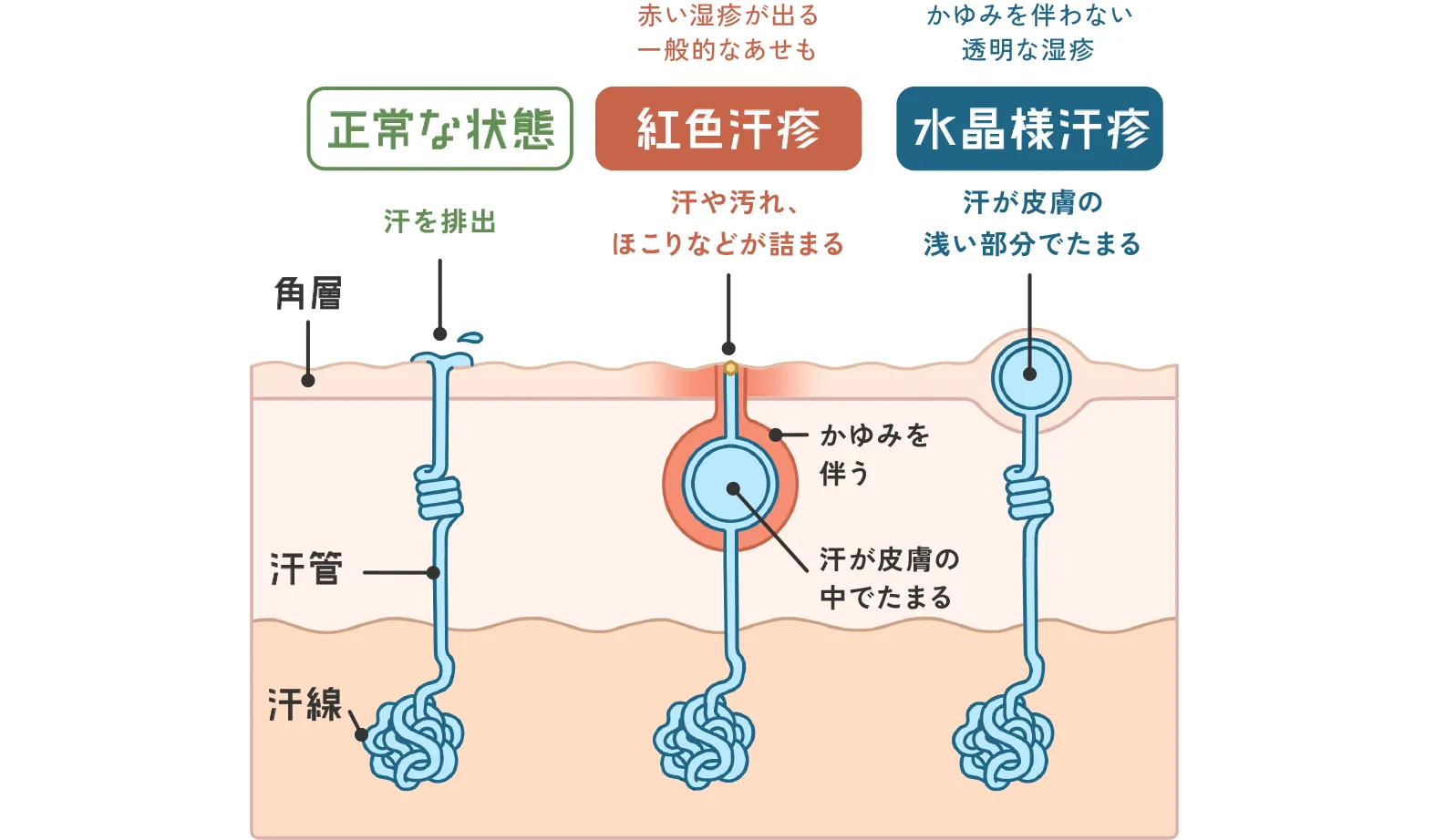 湿疹とは？原因と種類、ストレスからくる皮膚炎を画像で解説 - ヨクミテ医師監修の医療メディア