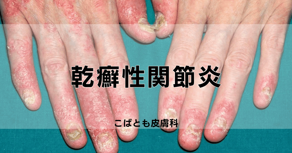 乾癬 - 上野御徒町ファラド皮膚科