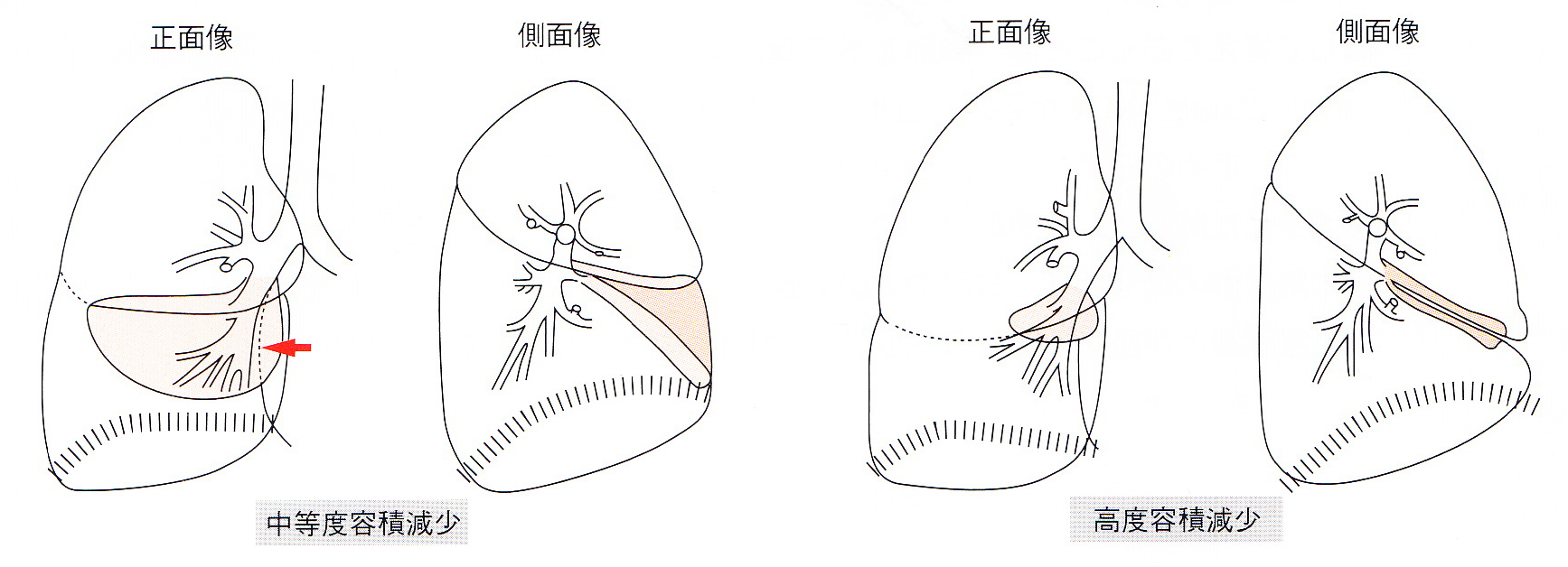 呼吸器外科疾患について藤田医科大学岡崎医療センター 呼吸器外科