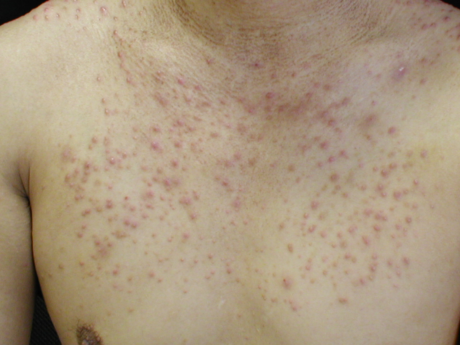 なぜ？「毛嚢炎 もうのうえん 」を繰り返す 早く治す方法は？膿は出してもいい？Medicalook メディカルック