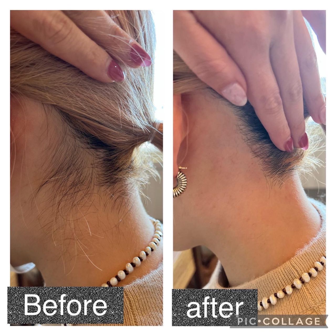 襟足 うなじ 脱毛は痛い？後悔しないために気をつけるべきポイントを解説医療脱毛ならルシアクリニック