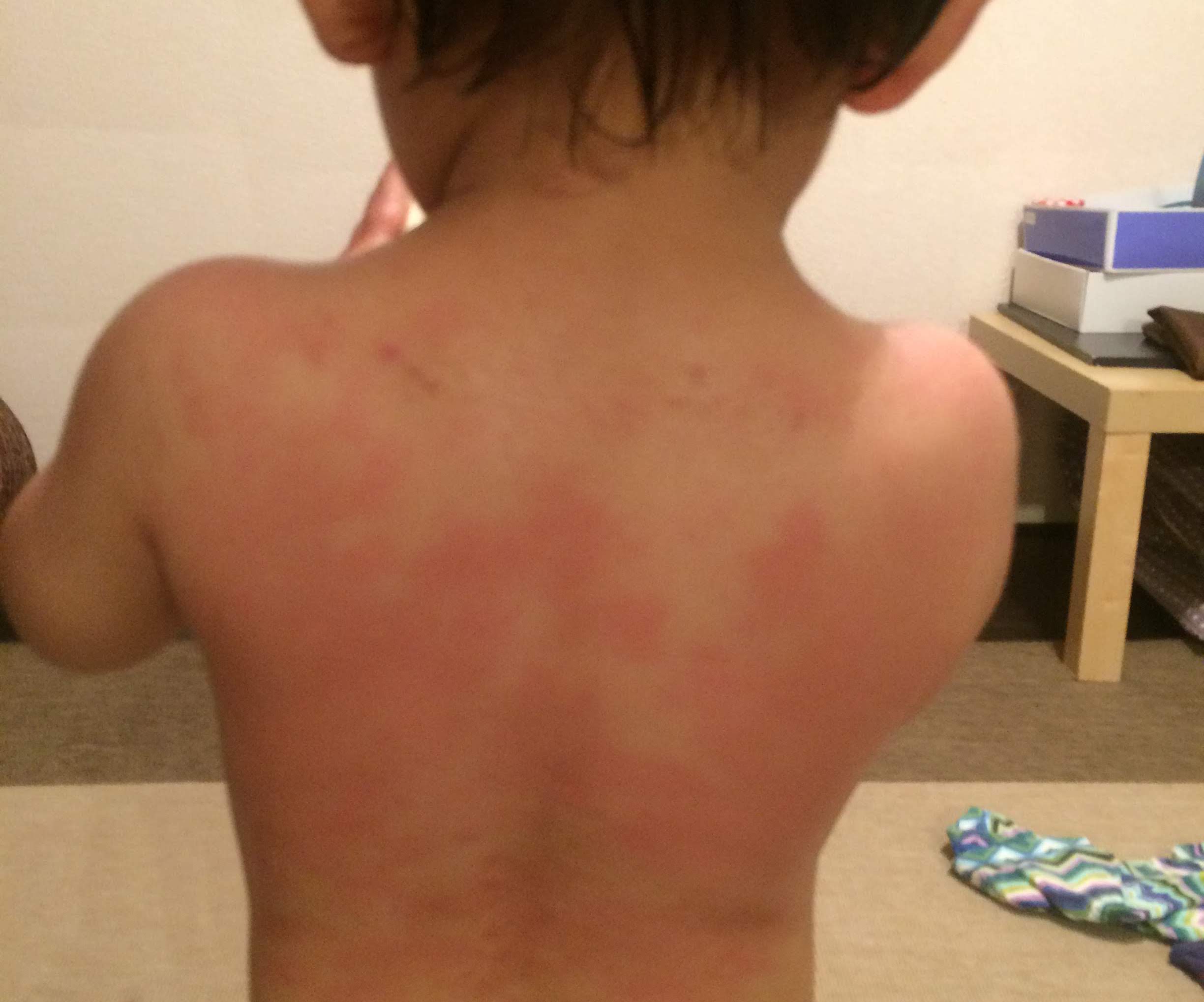 乳児は汗疹 あせも ができやすい？汗疹予防と汗疹ができたときの対応について - teniteo テニテオ