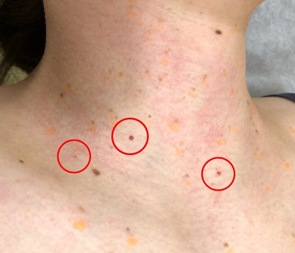 アトピー性皮膚炎の症状・原因くすりと健康の情報局