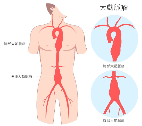 大動脈瘤ドクターが教える！病気あれこれ町田市民病院Machida Municipal Hospital