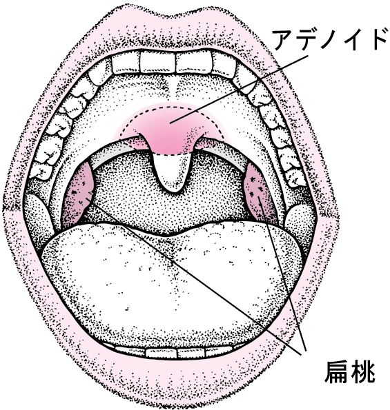 扁桃腫瘍 - 熊本 くまモンファン 耳鼻咽喉科医の みみ・はな・のど あれこれ