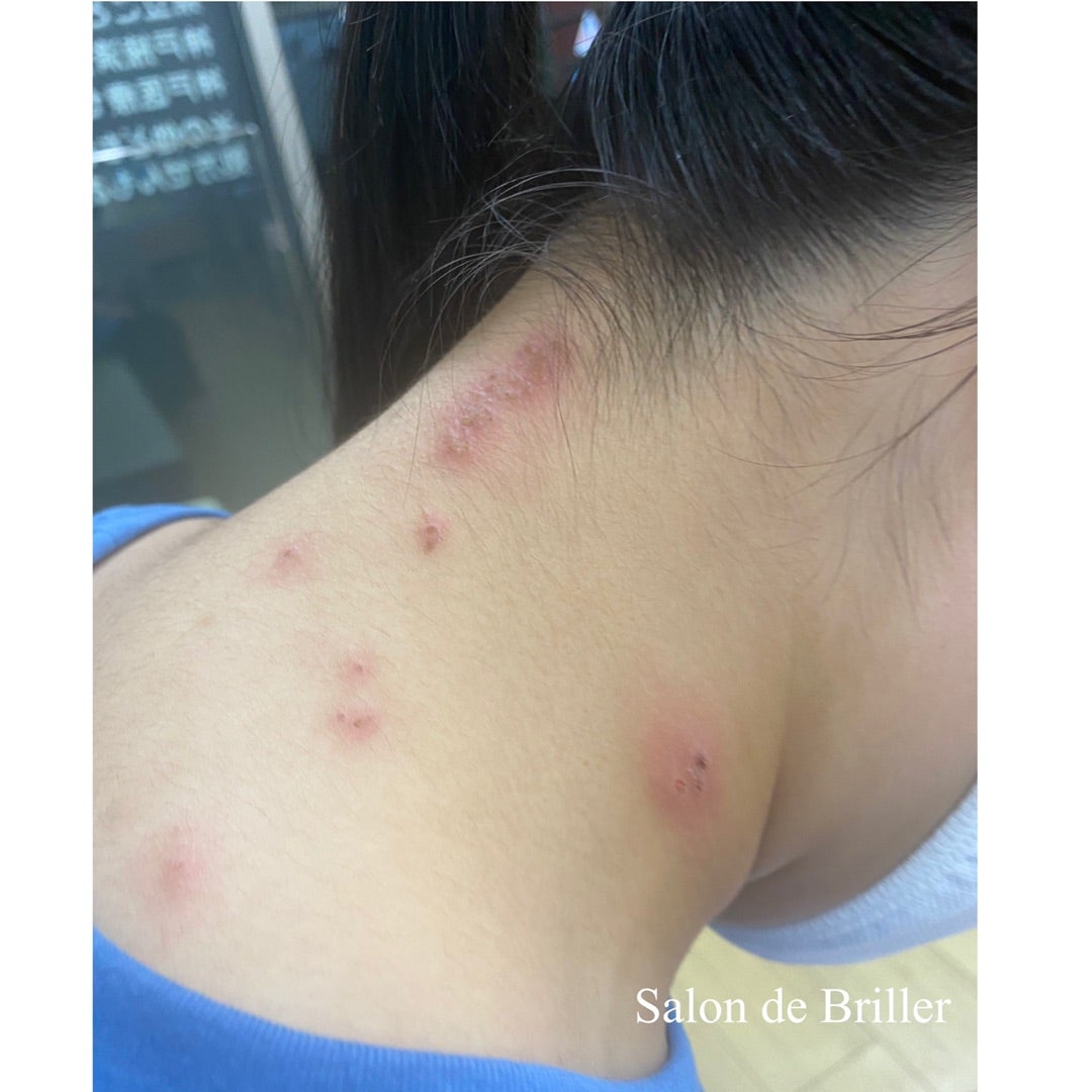 帯状疱疹むさし国分寺形成外科・皮膚科国分寺駅の皮膚科・形成外科・美容皮膚科・美容外科