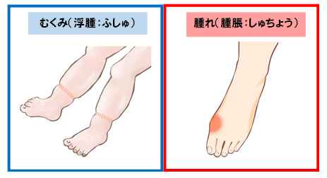 むくみ顔、足だけ国府クリニック
