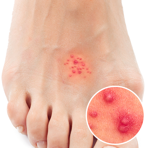 足に帯状疱疹が現れたら？症状の識別から日常ケアの秘訣までを徹底解説 - 中村AJペインクリニック