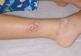 症例20：炎によるやけどつかもと内科