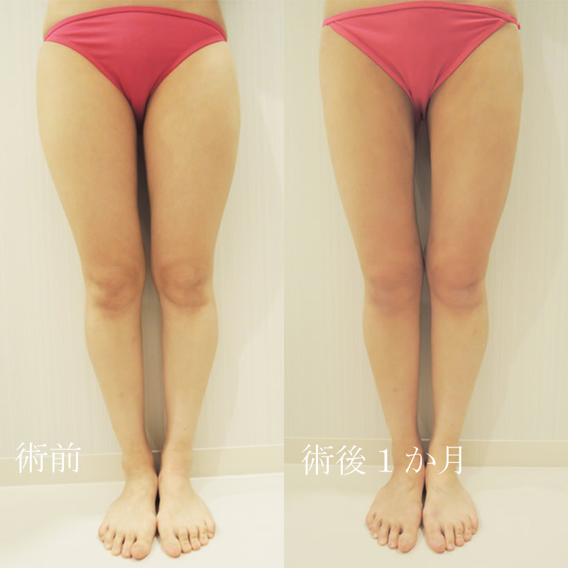 「変形性膝関節症とよく間違われる疾患５つについて」膝関節の痛みでお悩みの方、一度ご覧ください！！Dr.サカモトが詳しく解説します