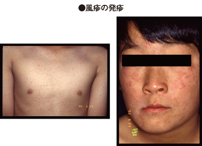 ウイルス性発疹症・水前寺皮フ科医院熊本市の皮膚科・形成外科・アレルギー科