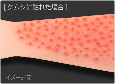 アブに噛まれて腫れ男 : 本日も晴天なり ちょっとそこまで自転車で