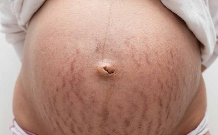 一度できたら消えない「肉割れ ストレッチマーク 」その原因とは？美容皮膚科 銀座よしえクリニック 公式 東京