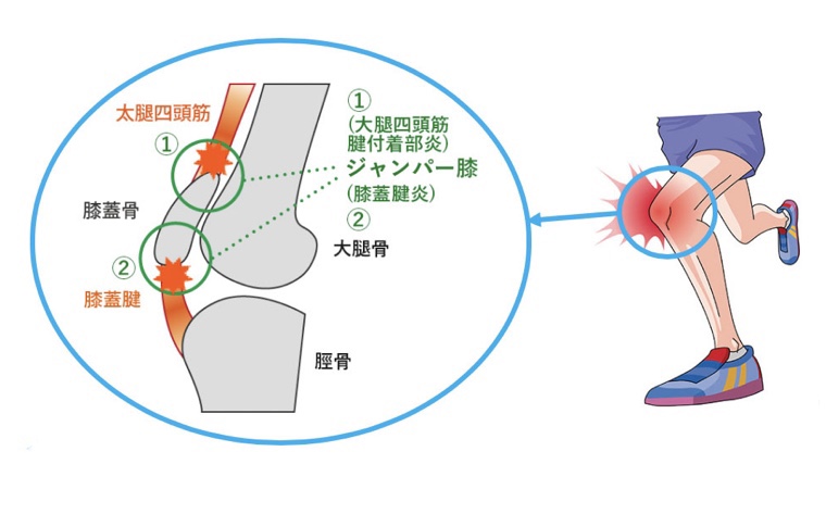 日々の症例 56 項靭帯石灰化症