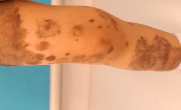 腕の痣-3の写真素材13849332- PIXTA