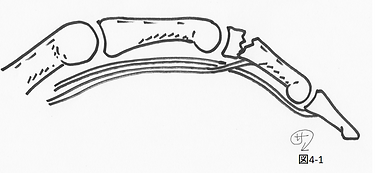 手指基節骨骨折 こけて指が変形しちゃった！- 古東整形外科・リウマチ科