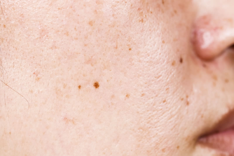 そばかすの原因や予防方法を医師が解説公式コラム美容整形・二重整形なら共立美容外科
