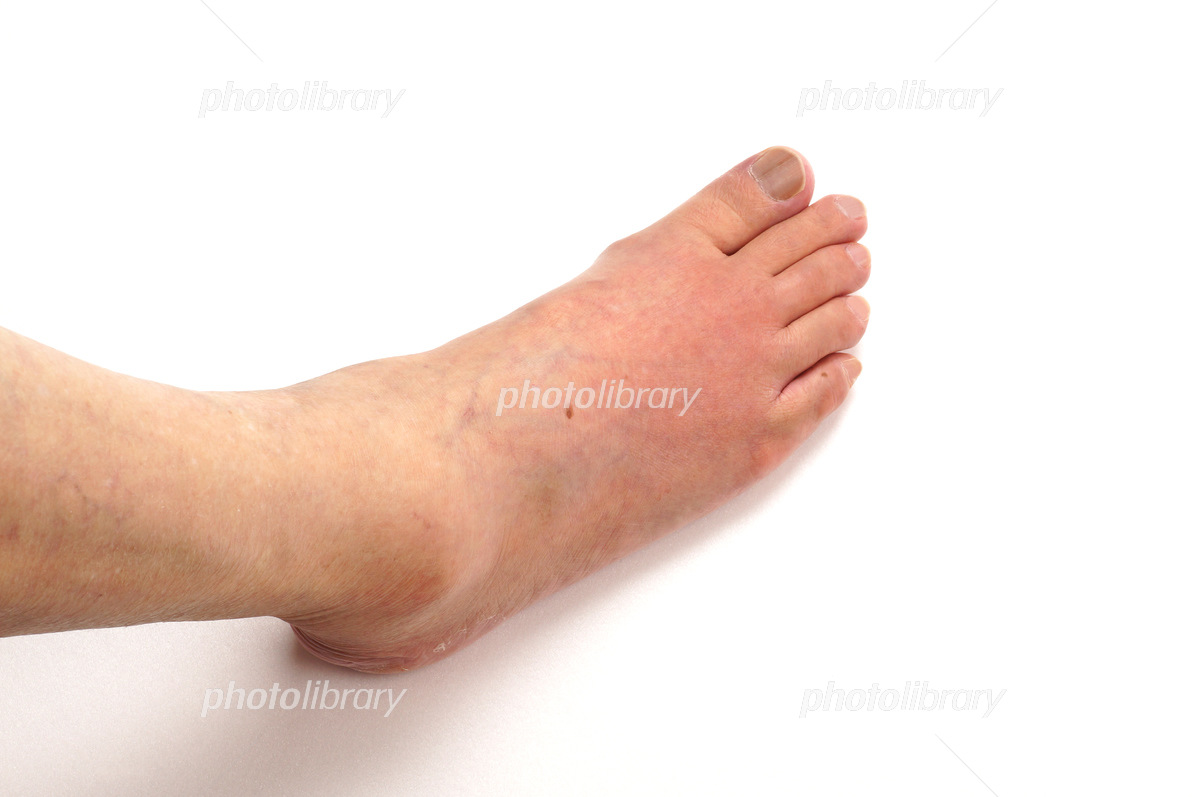 痛風にご用心 - かねみつクリニックオフィシャルサイト