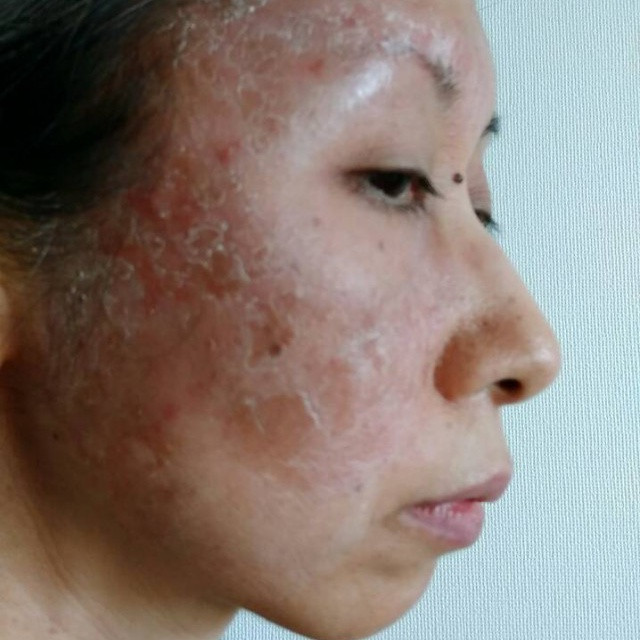 アトピー性皮膚炎治療モニター画像16 顔・鼻の痒み・炎症赤み改善 ！ ダチョウ卵黄ジェル レイドラテ・ラ・ポー 旧アトプロテクト- 美容外科美容皮膚科 奈良ピュアメディカルクリニック