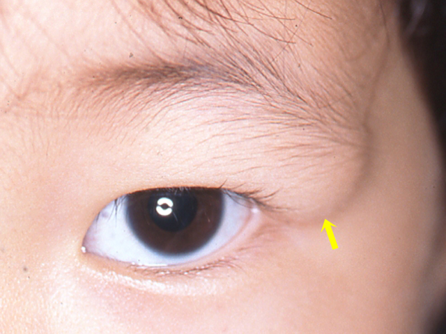 青あざ 異所性蒙古斑・太田母斑 の治療日本医科大学武蔵小杉病院