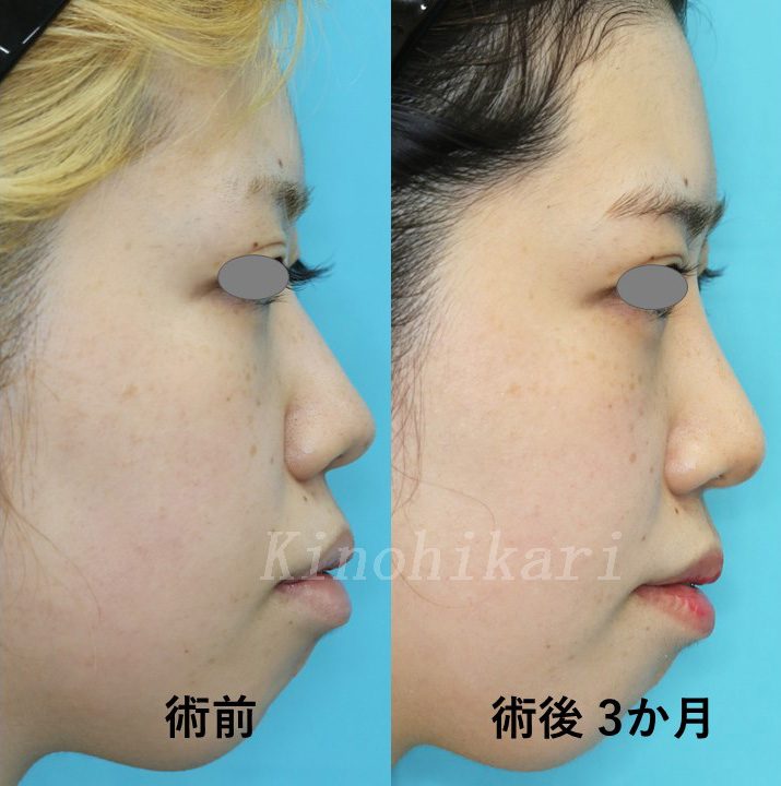 斜鼻修正術コントアクリニック東京