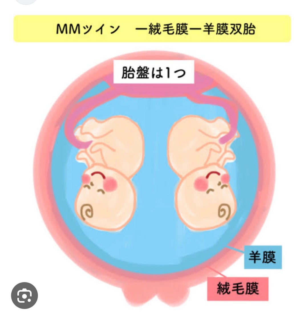 不妊治療により多胎児が増加？ふたご妊娠のメカニズム子育て情報メディア「KIDSNA STYLE」