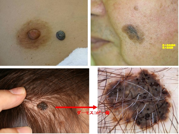 皮膚線維腫の日帰り手術 - オーシャンブリッジ高山のブログ