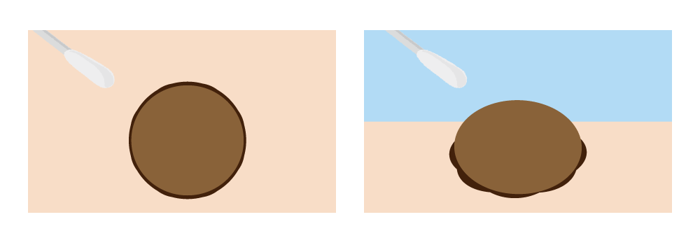 写真で見る尖圭コンジローマの症状ー尖圭コンジローマは完治するの？メディカルノート