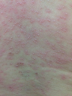 汗疹 あせも の鍼灸治療の症例名古屋市中川区高畑の蓬祥鍼灸院