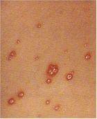 水いぼ 伝染性軟属腫 吹田市の皮膚科もりはら皮ふ科クリニック