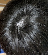 高校生男性 若ハゲの恐怖。親子で頑張り薄毛改善公式 スーパースカルプ発毛センター寝屋川枚方店