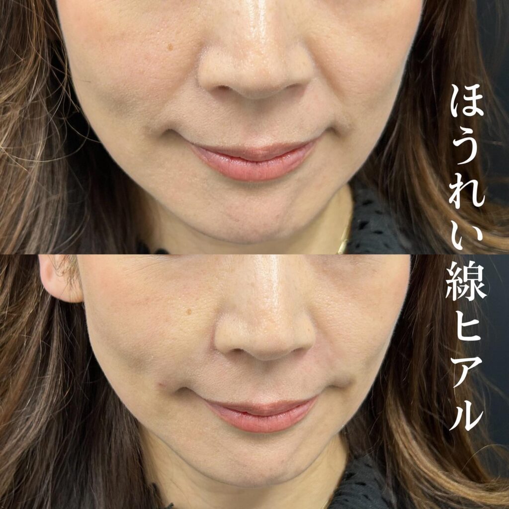 ほうれい線ケアを学ぼう！田辺花穂の簡単美容法