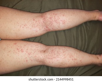 毛嚢炎 毛包炎 とは？原因や対処方法を解説美容脱毛サロン ミュゼプラチナム