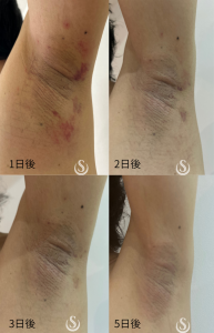 脇脱毛でワキガが治った？ワキガが悪化した際の対処法やセルフケア6選札幌の医療脱毛ならアステリアクリニック 公式