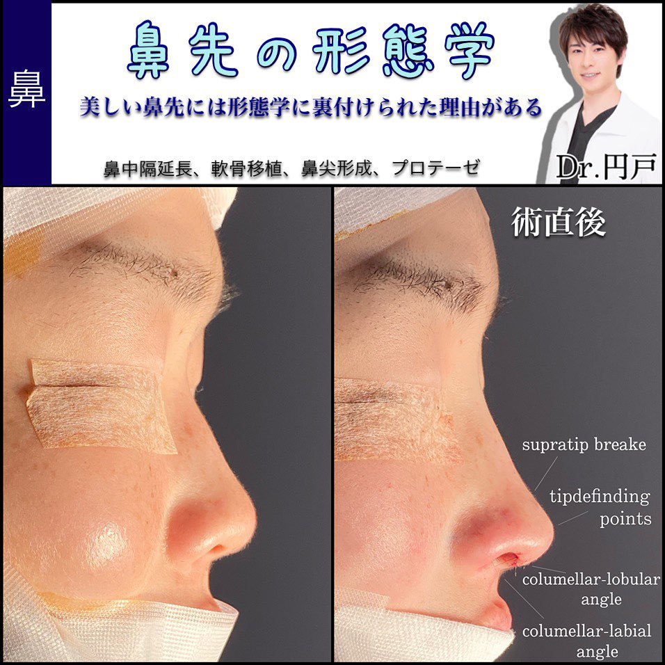 鼻を高くしたい方必見！自力で鼻を高くできる可能性がある方法をご紹介金沢の美容整形・美容外科はeクリニック