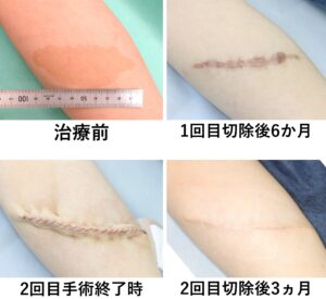 しこり摘出手術船橋ゆーかりクリニック形成外科で