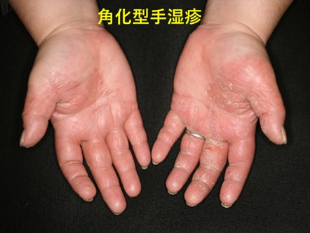 治療日誌 手湿疹 No.2伝統鍼灸 楓庵