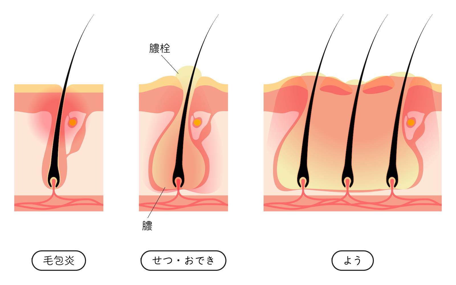 医療従事者監修 お尻のできもの ブツブツ が治らない！治し方は？跡や黒ずみが残ったときの対処方法ニキビ、ニキビ跡、赤ら顔の改善なら渋谷美容外科クリニック