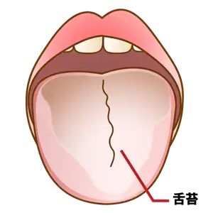 口臭を引き起こしやすい地図状舌と溝状舌について大阪口臭センター・ほんだ歯科口臭外来部 Dr.本田のブログ～口臭症治療・ドライマウス・アンチエイジング～