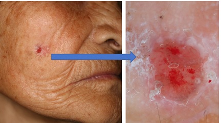 毛孔性苔癬は背中や二の腕に出来やすいけど、頬にもできます。 毛孔性苔癬鮫肌毛穴毛穴トラブル角栓毛穴タイプTikTok