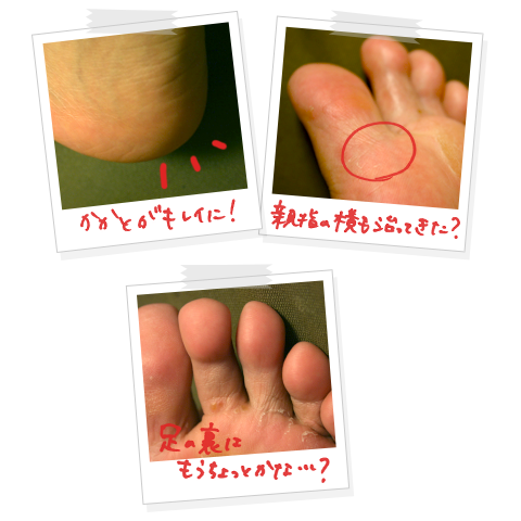 水虫がうつる原因は？お風呂や布団は大丈夫？家族にうつさない予防対策