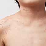 汗疹 あせも私の治療– 日本医事新報社