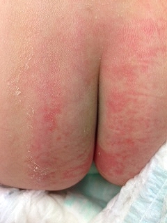 お尻のぶつぶつはニキビ？検査・治す方法を解説 画像あり 池袋マイケアヒルズタワークリニック