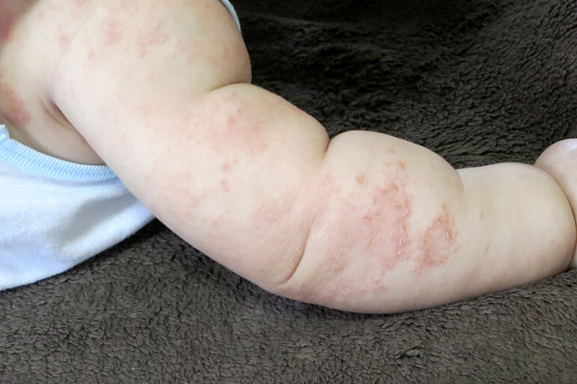 乳児湿疹ができる原因は？症状とスキンケア方法BELTA