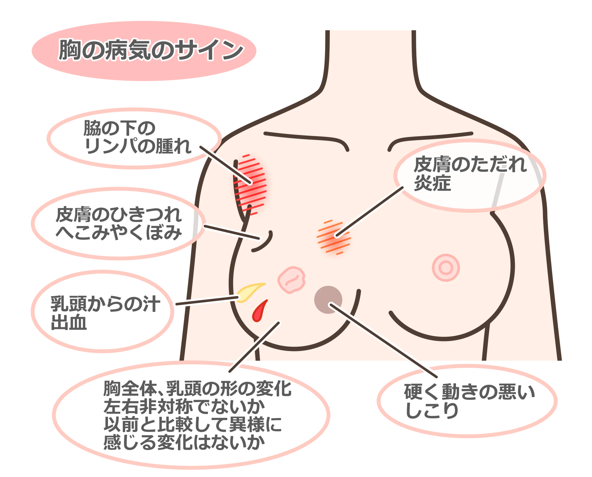 胸部の粉瘤 - 粉瘤 皮膚外科 他