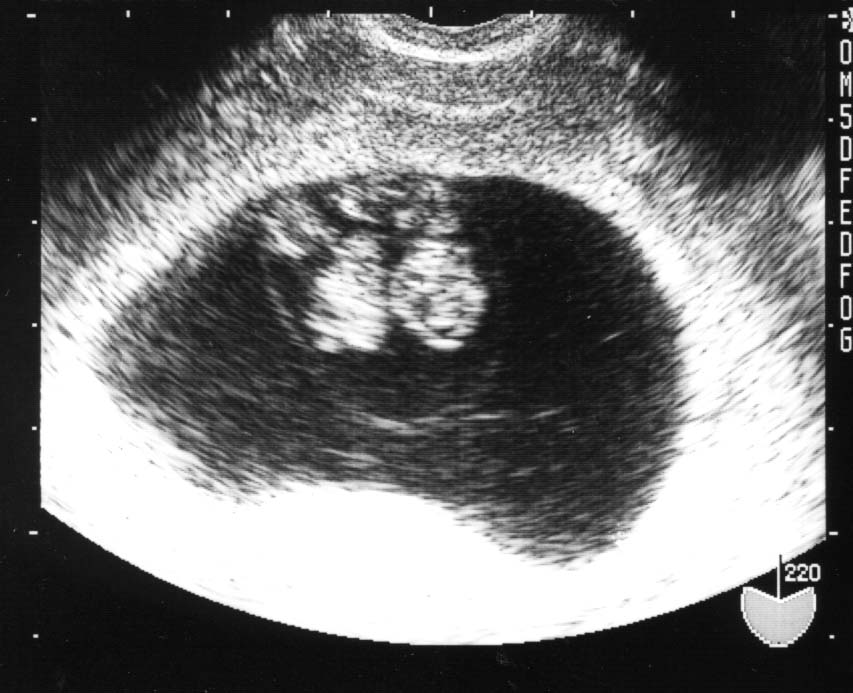 双子の妊娠 多胎妊娠 リスクや注意点、管理方法を解説社会福祉法人交響