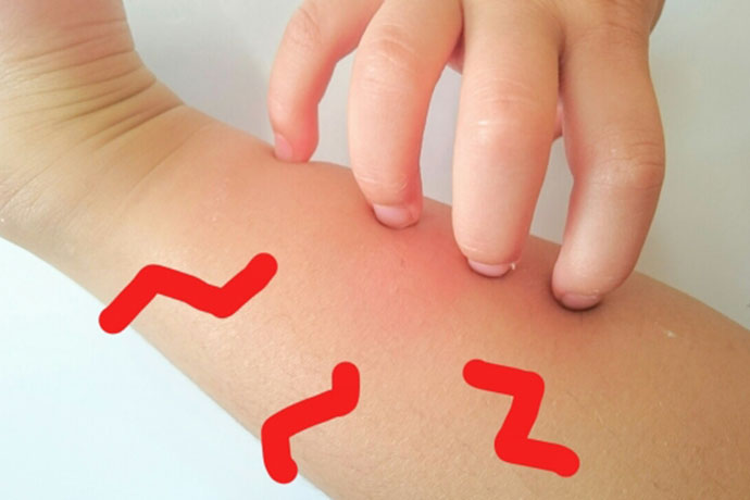 赤ちゃんや子どもが蚊に刺されたら？ パンパース