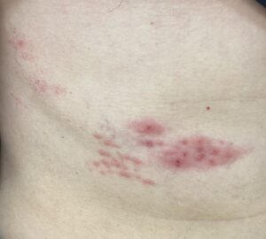 医師監修・作成 帯状疱疹の画像7点：初期症状のかゆみ、赤み、水ぶくれとかさぶたMEDLEY メドレー