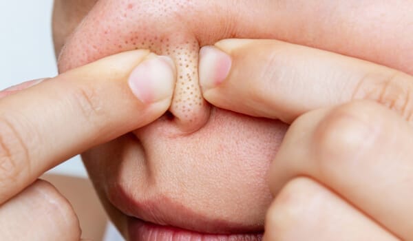 小学3年生の子供の顔にブツブツが増えてきて困っています。皮膚科にも通- Yahoo!知恵袋