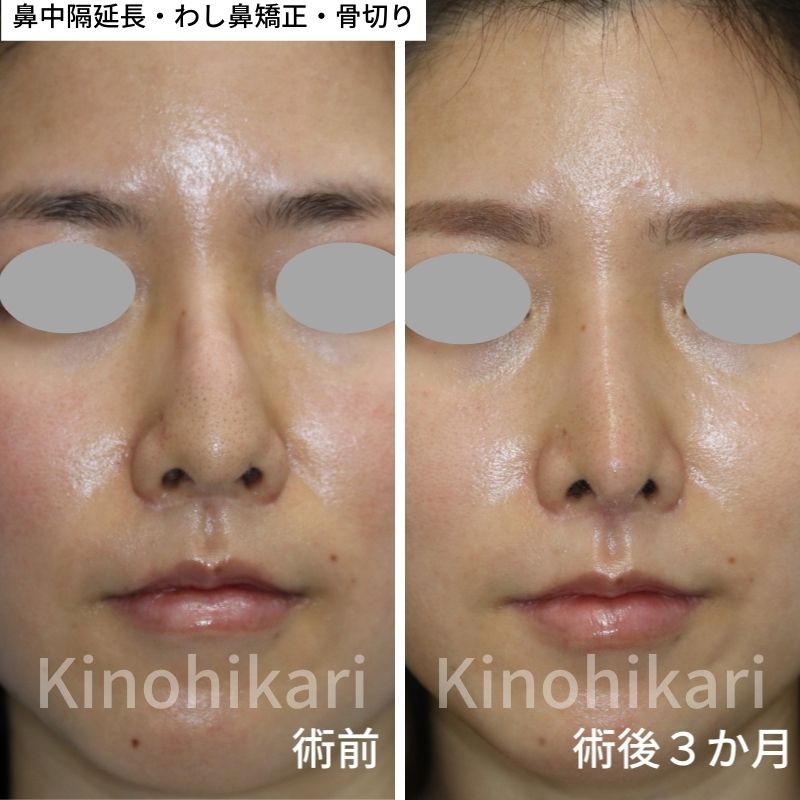 斜鼻修正 東京・新宿鼻の整形なら東京イセアクリニック
